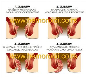 hemoroidi stadijum