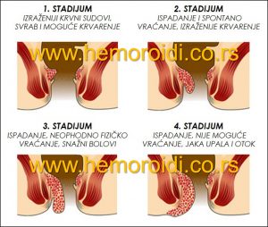 hemoroidi stadijumi